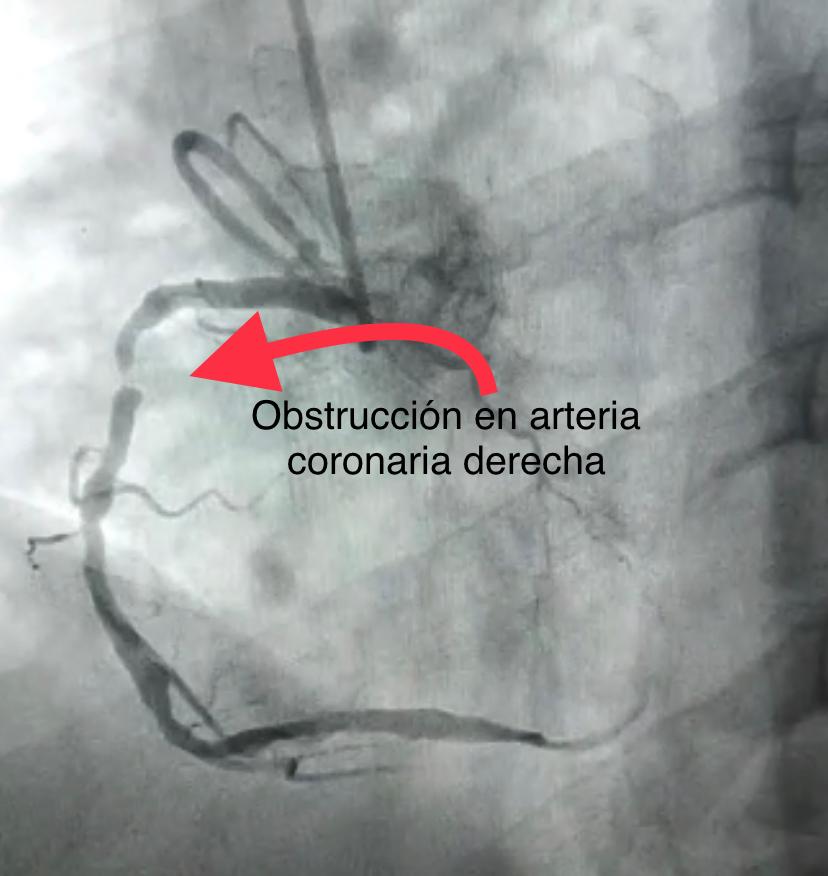 obstrucción en arteria
